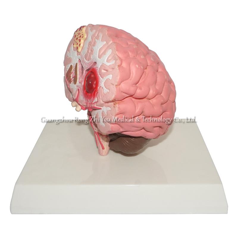 brain stroke demonstration model