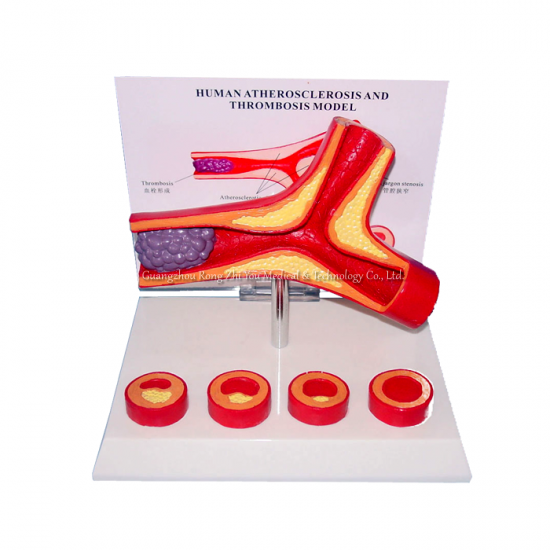 modelo anatómico de la arteria aterosclerosis
