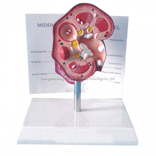 modelo patológico de cálculo renal