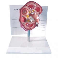 modelo patológico de cálculo renal