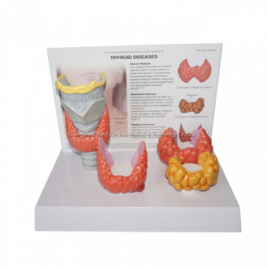 modelo de anatomía de enfermedades tiroideas