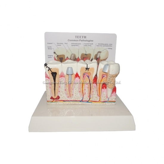 modelo de dientes patológicos