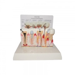 modelo de dientes patológicos