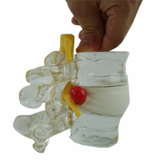 modelo de hernia de disco lumbar