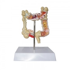 modelo de colon enfermo