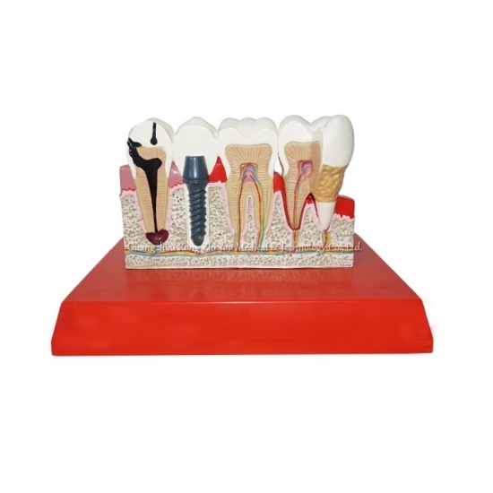 modelo de patología de los dientes