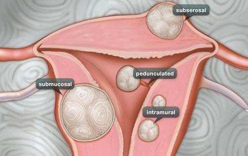 tres tipos de grupos de fibroides uterinos de alto riesgo, ¿qué métodos pueden prevenir?